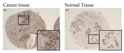 Cadherin-23 in Breast Cancer Cells