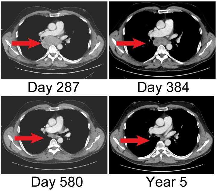 Tumor Regression after Combined Immunotherapy