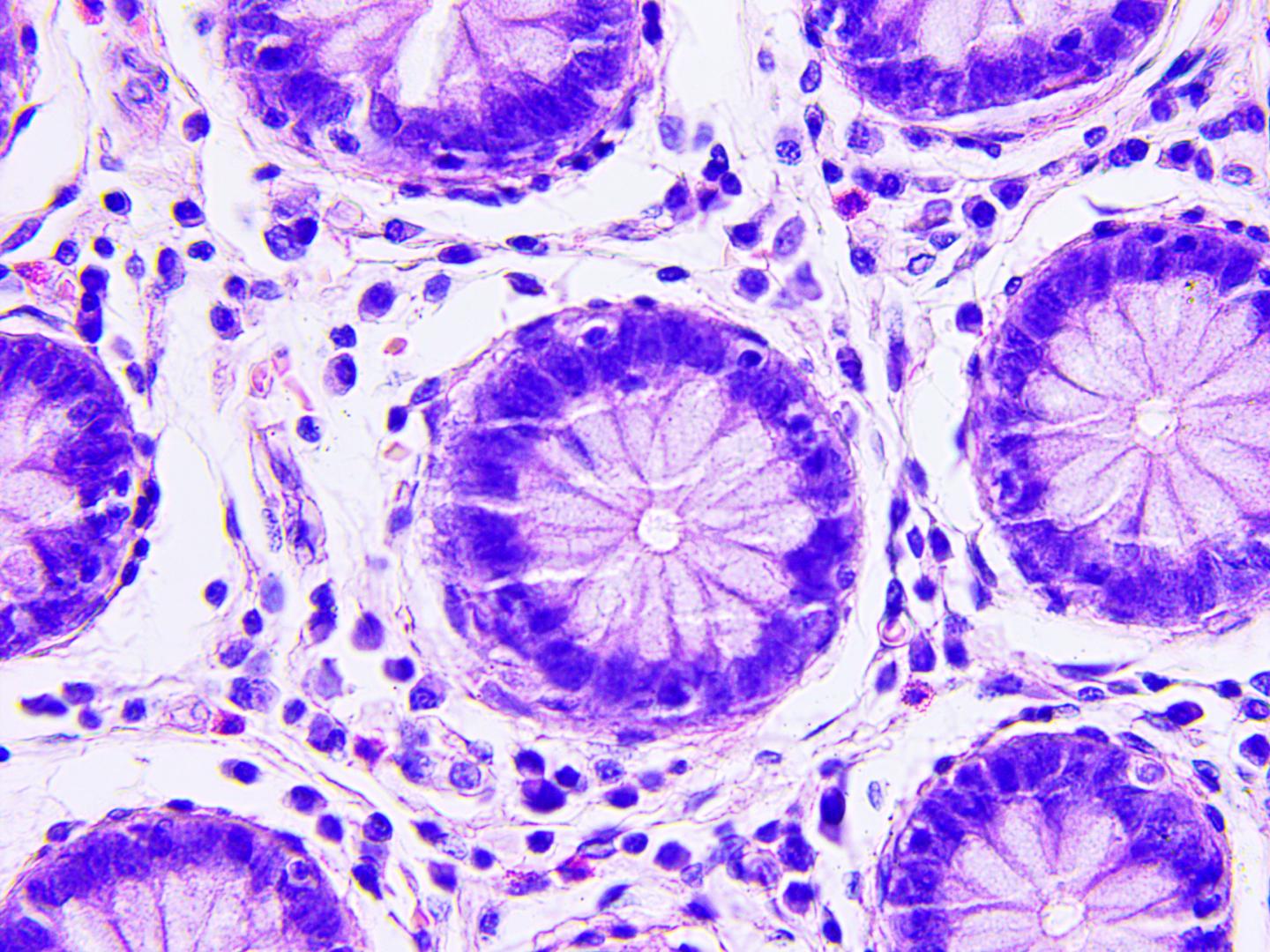 Colon Cancer Cells