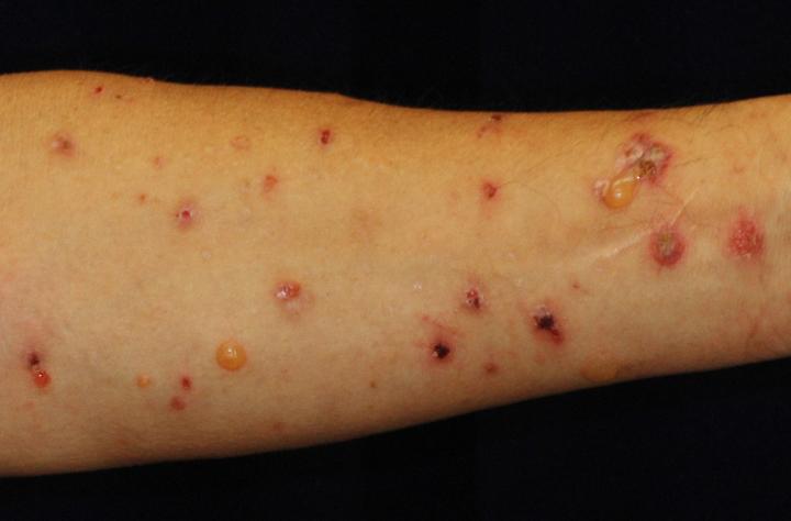 Photograph of the Skin Disease