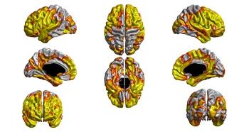 Thickness of the Cortex at Age 73 Associated with the Amount of Lifetime Smoking