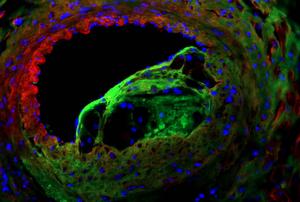 Left anterior descending coronary artery with atherosclerotic lesion immunofluorescently stained for alpha-smooth muscle cell (green), collagen-I (red) and nuclei (blue) in an animal model.