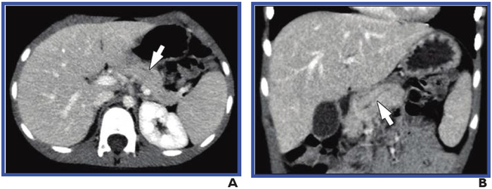 Duct Dilation on CT in 6-Year-Old Boy With Chronic Pancreatitis