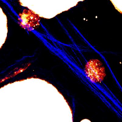 Lipid-Rich Cancer Cells