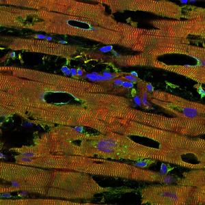 Heart tissue from a patient with chronic heart disease due to dilated cardiomyopathy.