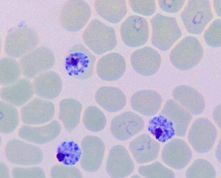 Microscopic Image of Human Red Blood Cells infected with Malaria Parasite Plasmodium falciparum