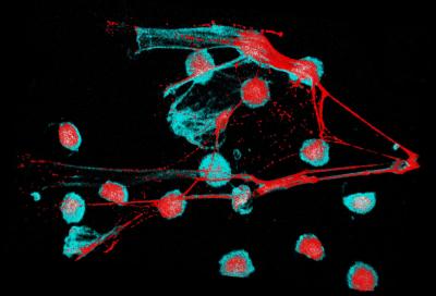 White Blood Cells and NETs in a Lupus Patient