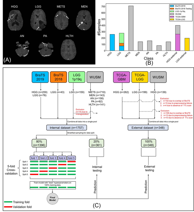 Deep Learning Model Classifies Brain Tumors with Single MRI Scan