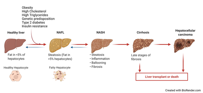 Non alcoholic Fatty Liver Dise IMAGE EurekAlert Science News Releases