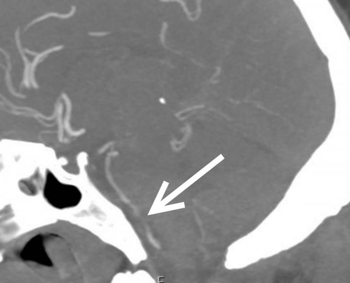 Diabetes, Hypertension May Increase Risk of COVID-19 Brain Complications
