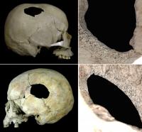 Perimortem blunt force injuries on skulls from archaeological sites at Hokkaido, Japan