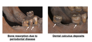 Figure 1. Periodontal disease observed in skeletons from the Edo period.