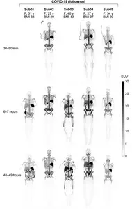 Scans from recovering COVID19 patients