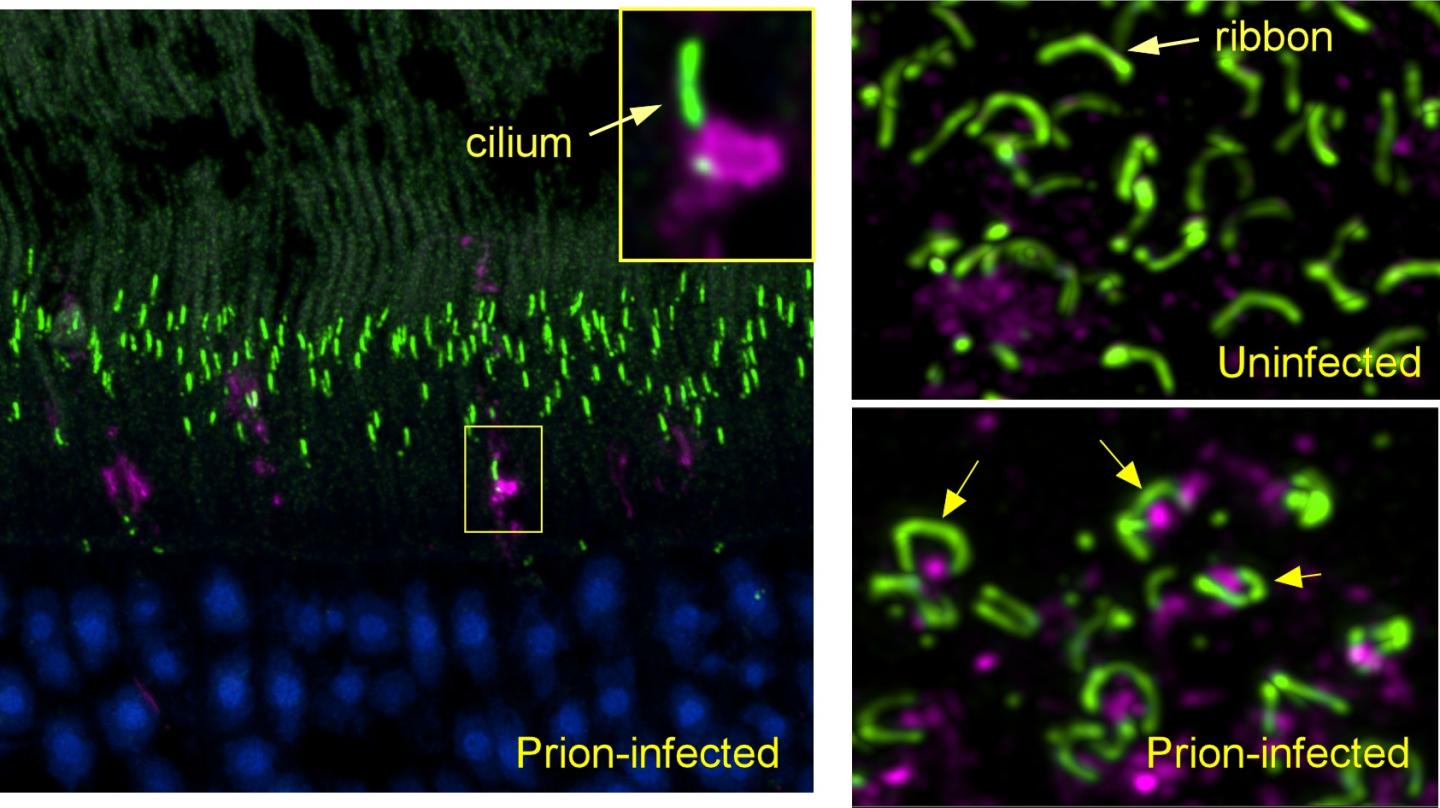 prion infection