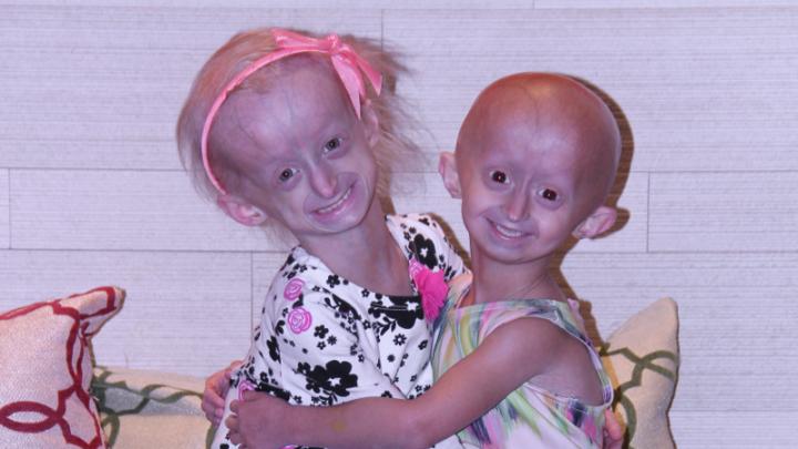 Progeria Patients
