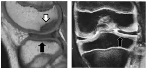 Discoid lateral meniscus and osteochondritis dissecans in adolescent patients