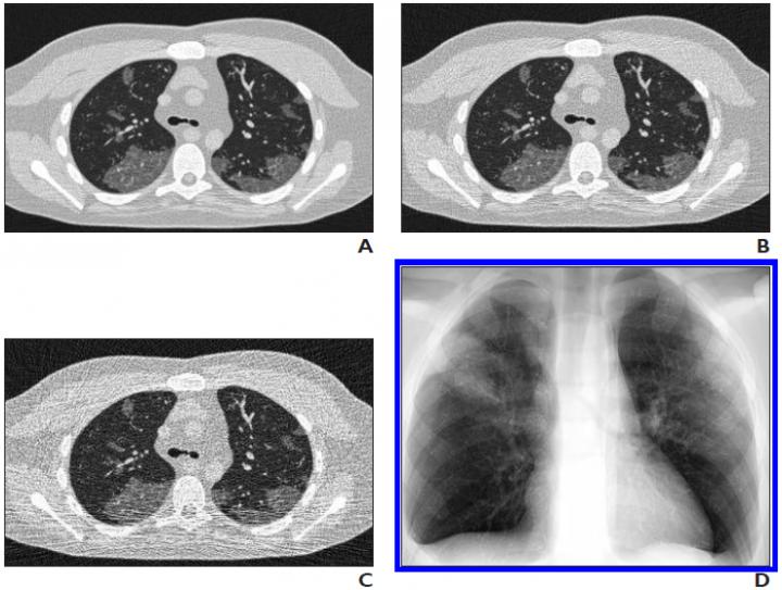 Simulated CT Images of COVID-19 on 4D XCAT Phantom