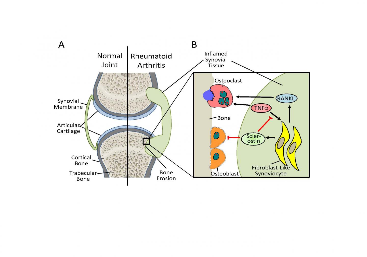 Osteoporosis Drug Unexpectedly Drives Arthritis (2 of 2)