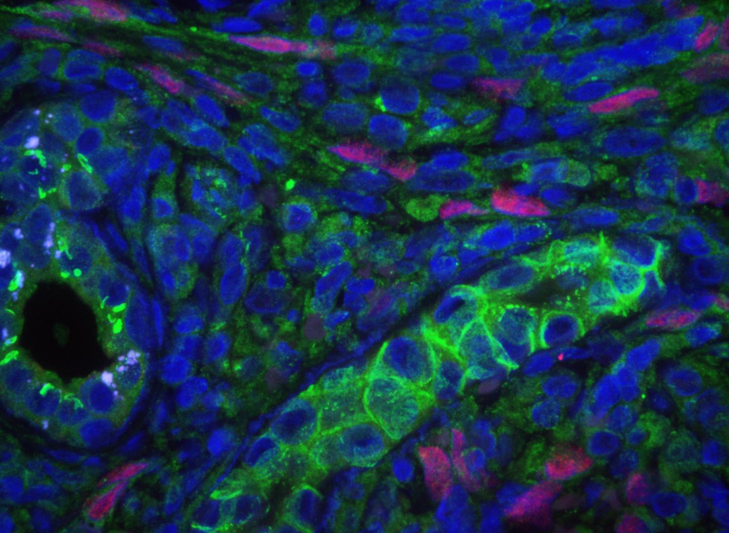 Confocal Image of a Kaposi´s Sarcoma Tumor