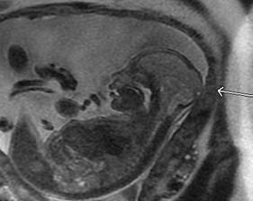 Encephalocele in a Zika-Exposed Fetus