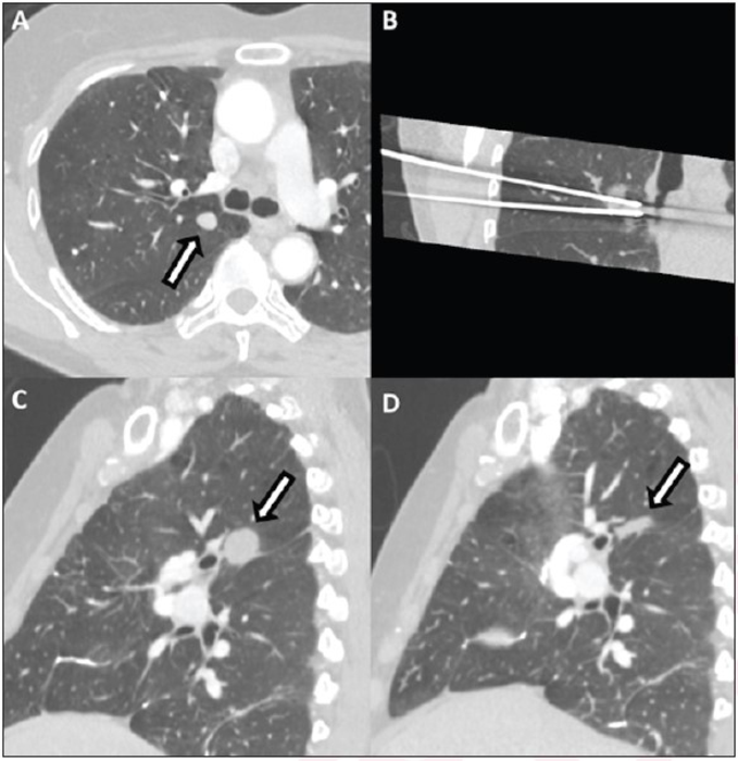 Percutaneous Cryoablation of Central Right Upper Lobe Chondrosarcoma Metastasis in 56-Year-Old Woman