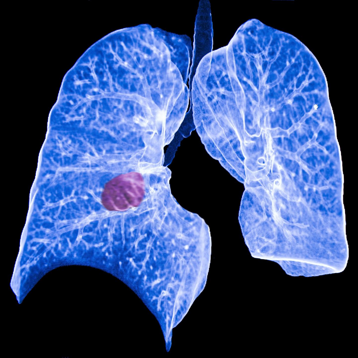 Lung Cancer