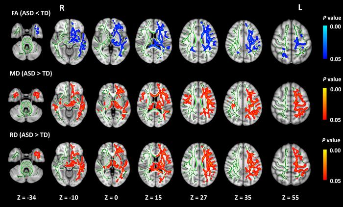 Comparison of various brain connectivity parameters between children with and without autism spectrum disorder