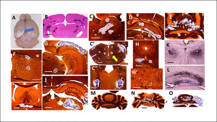 Intracranial Calcifications