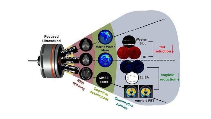 Focused ultrasound can awaken the brain immune system in mice