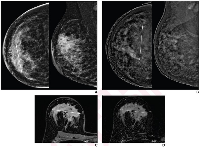 Mammography: Masses - Radiology