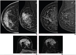 41-year-old woman with invasive ductal carcinoma (G2, luminal B) of right breast