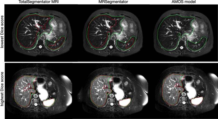 AI Model Automatically Segments MRI Images