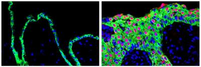 Skin Repair Protein Gone Awry in Cancer