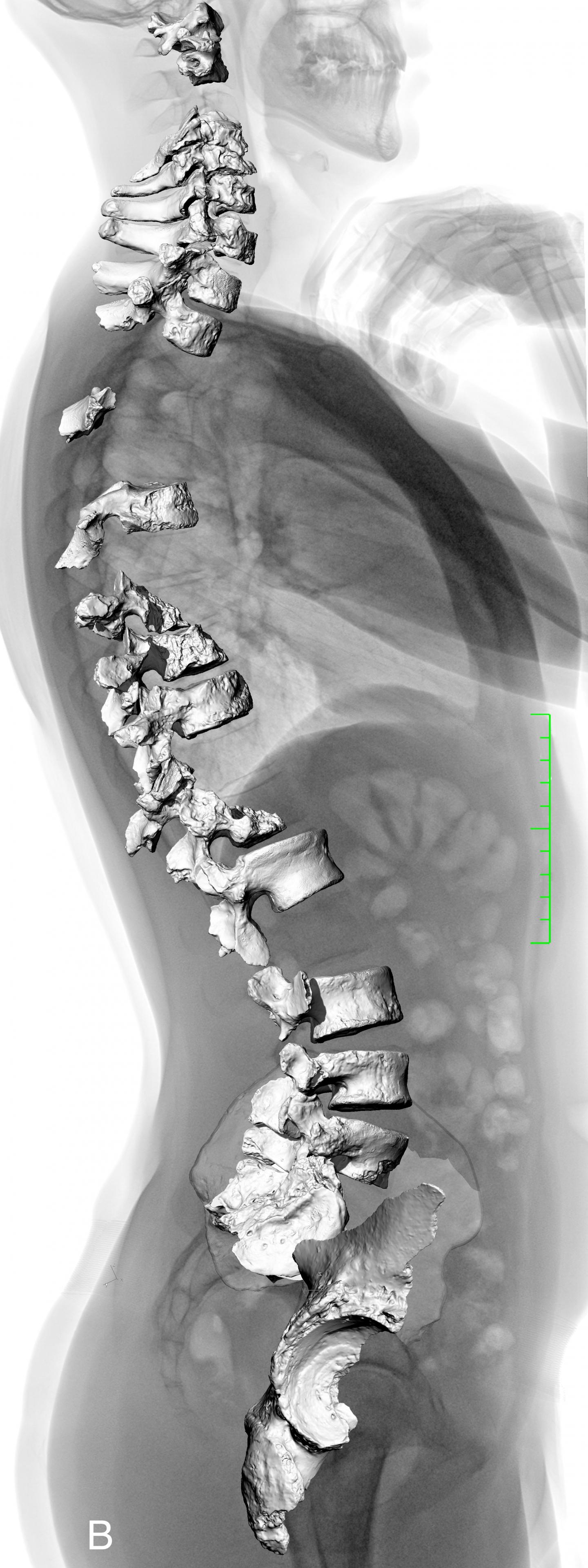 The La Chapelle-aux-Saints Vertebrae, Superimposed on a Full Body Radiograph of a Modern Human