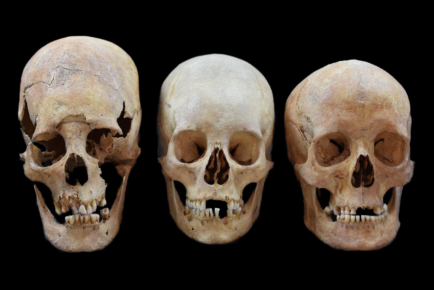 A Deformed, Intermediate, and Non-deformed Human Skull