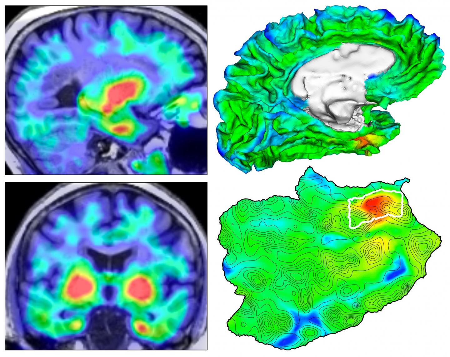 Automated Imaging Reveals Where TAU Protein Originates in the Brain in Alzheimer's Disease (1 of 3)